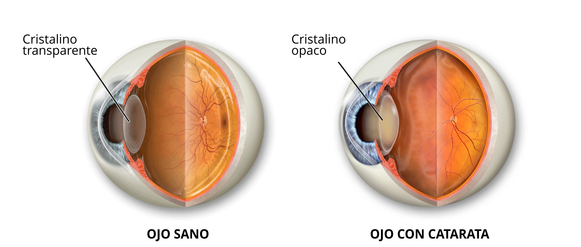 Diferencia entre ojo sano y ojo con catarata.